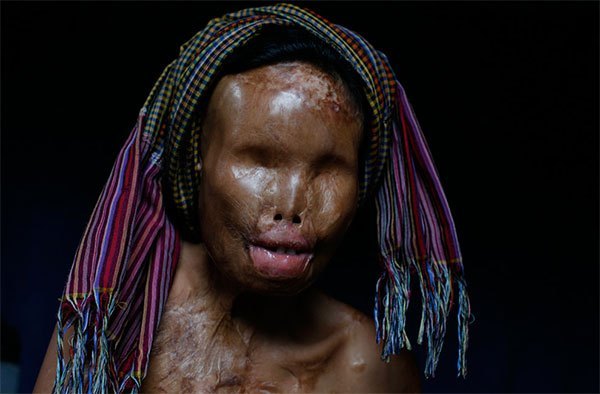 acid-attacks-continue-to-destroy-lives