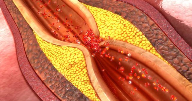 Are higher iron levels actual shields for arteries iron