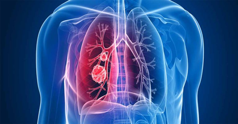 Can antioxidants hasten the spread of lung cancer? Global Village Space Can antioxidants hasten the spread of lung cancer? Global Village Space
