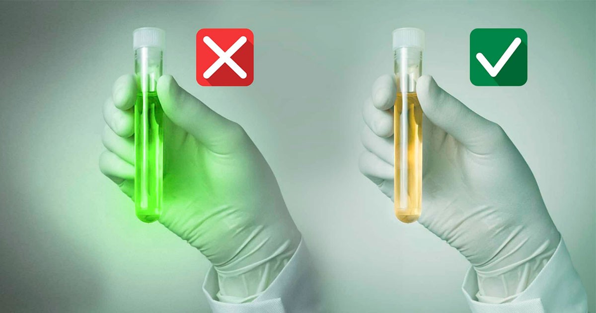 urine test for prostate cancer detection)
