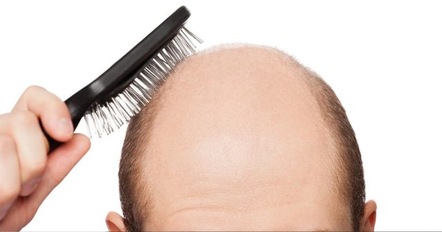 Men and hair loss – an unavoidable animosity Men