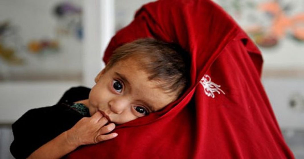 Pakistan ranked second to Afghanistan in stunting index