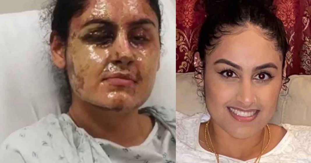 acid attack on Pakistani student