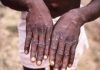 WHO alarms about monkeypox
