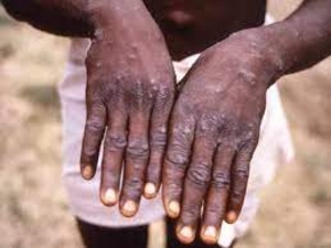 WHO alarms about monkeypox