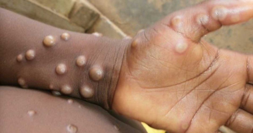 India first monkeypox case