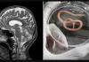 Live Worm Found in Woman's Brain