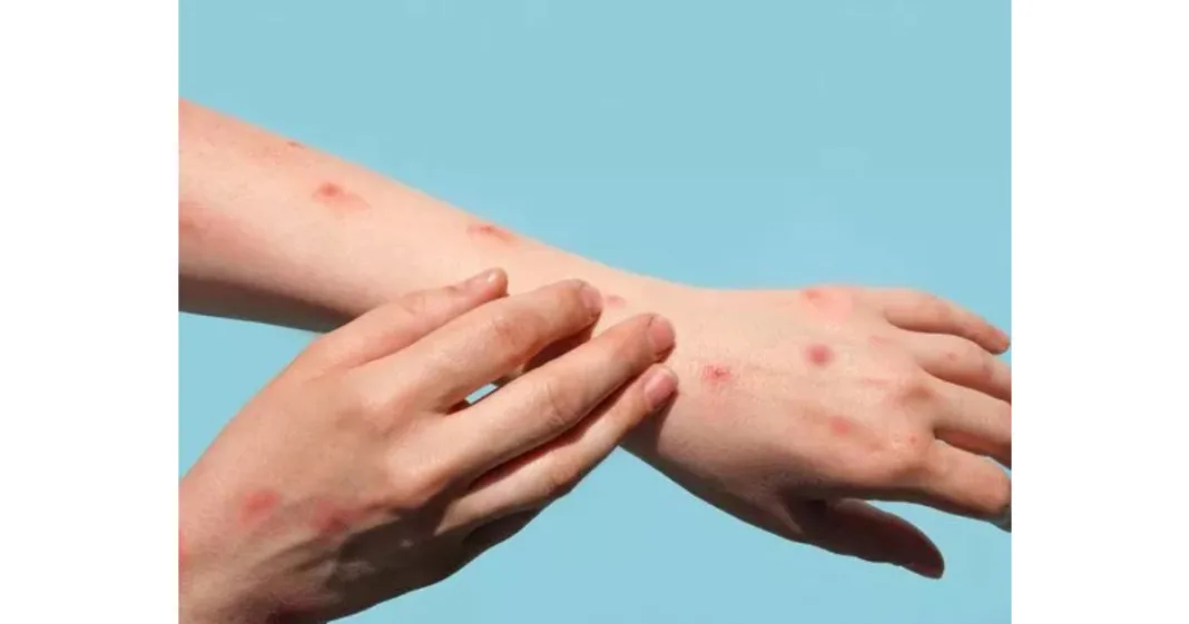 Airport Screening Failures Spark Concern Amid Rising Mpox Cases in Pakistan