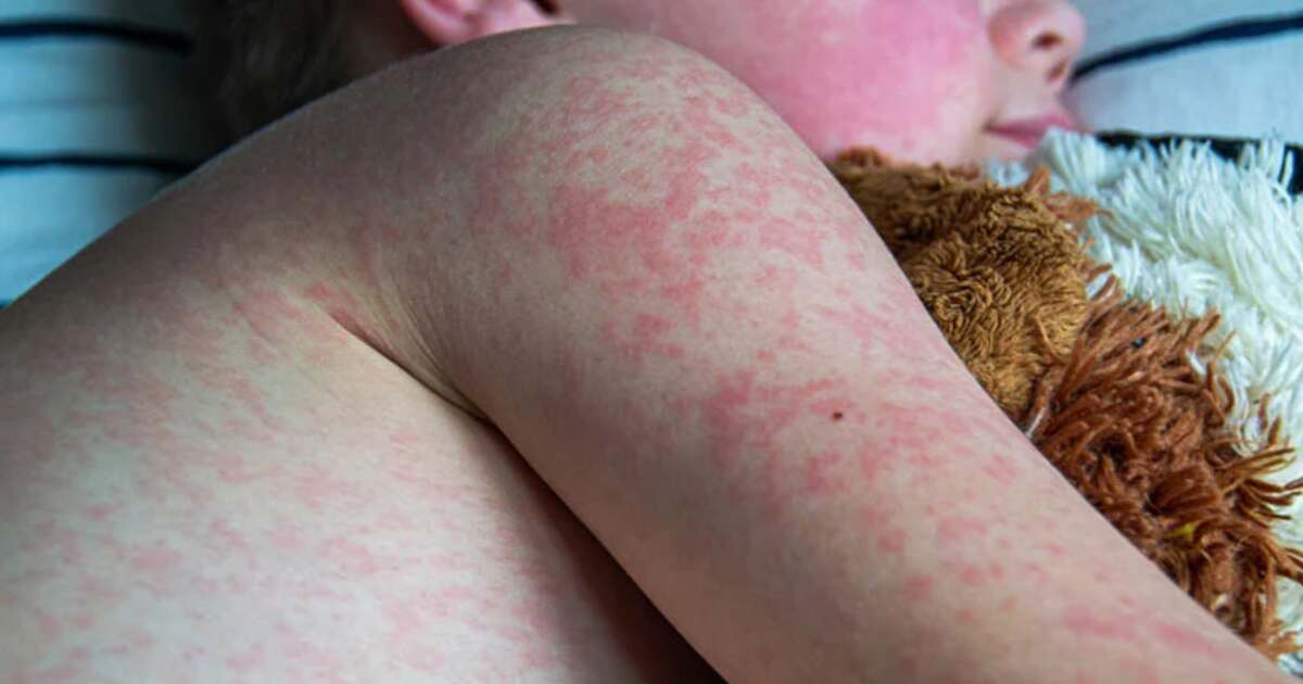 Measles outbreak spreads in Texas and New Mexico - Global Village Space