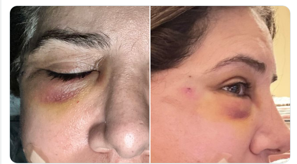 Pak TV anchor shares photos of domestic abuse